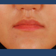 Illustration for article titled New Plastic Surgery Trend